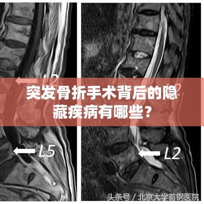 突发骨折手术背后的隐藏疾病有哪些?