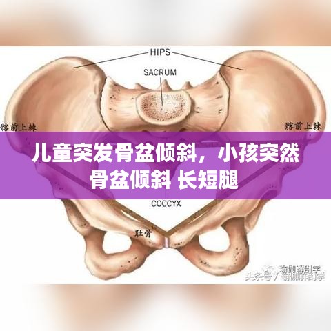儿童突发骨盆倾斜，小孩突然骨盆倾斜 长短腿 