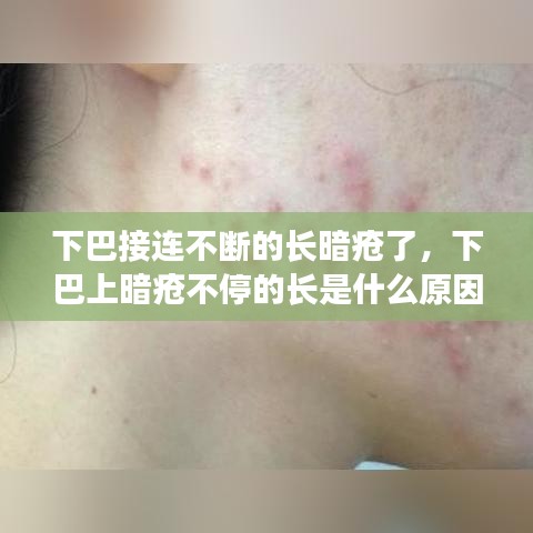 下巴接连不断的长暗疮了，下巴上暗疮不停的长是什么原因 