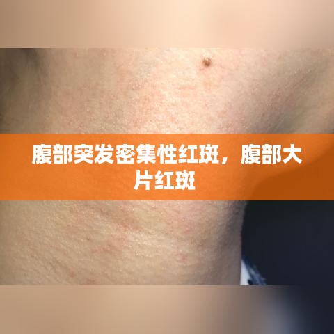 腹部突发密集性红斑,腹部大片红斑