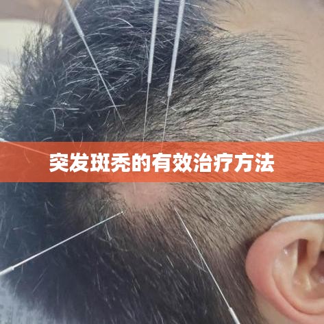 突发斑秃的有效治疗方法